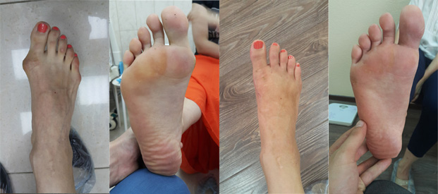Лечение косточки на большом пальце ноги в краснодаре