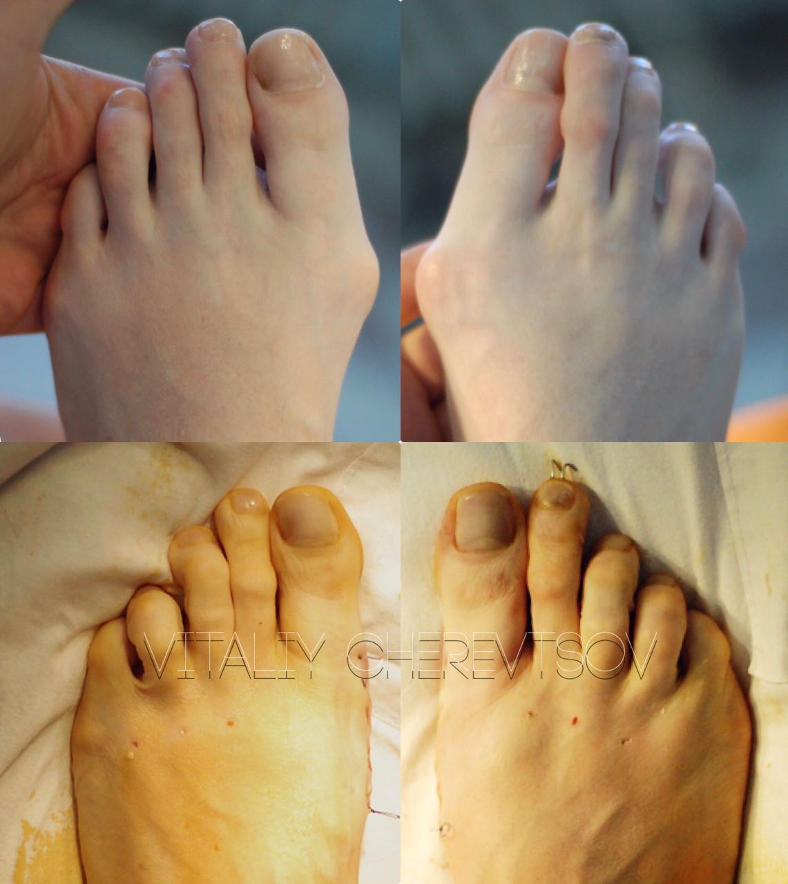 Лечение косточки на большом пальце ноги в краснодаре