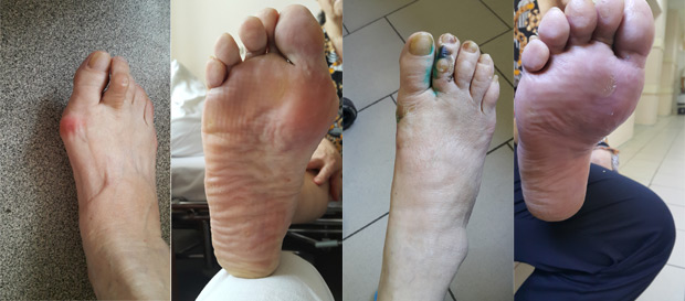 Косточки ногах лечение краснодар thumbnail