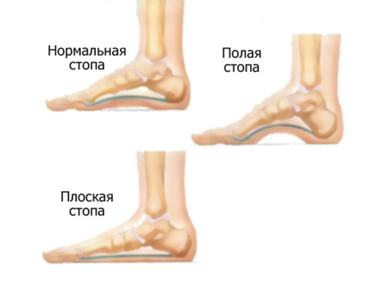 Диагностика и методы лечения конской стопы - как выбрать ортопедическую обувь для детей в Новосибирске
