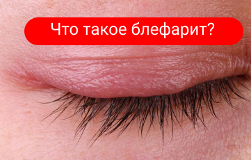 Что такое Блефарит?