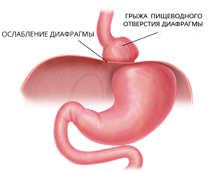 Лечение грыжи пищевого отверстия диафрагмы в Краснодаре