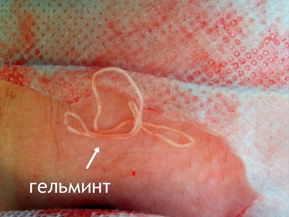 Клинический случай дирофиляриоз