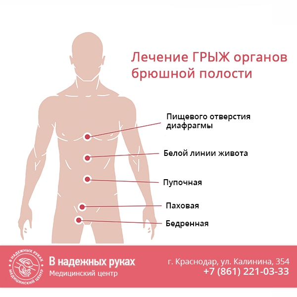 Лечение грыж органов брюшной полости