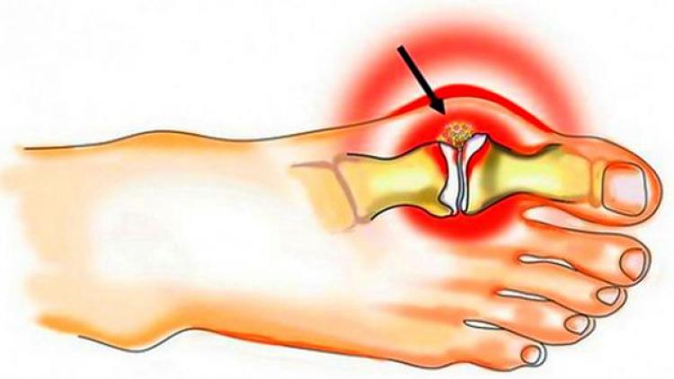 Вальгусная деформация стопы («шишечки» на ногах, «Hallux valgus») – что же это такое?