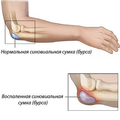 Бурсит локтевого отростка