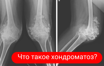 Хондроматоз — что это?
