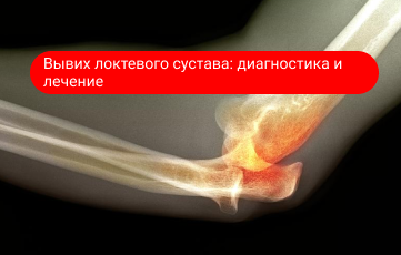 Вывих локтевого сустава — причины и восстановление