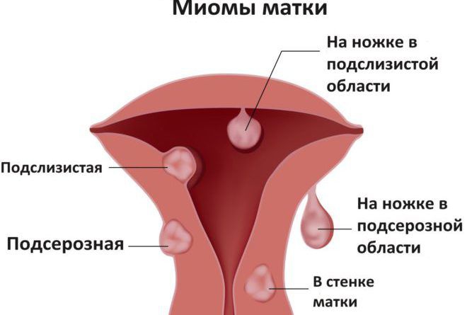 Миома матки, диагностика и лечение в Краснодаре