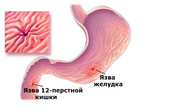 Язвенная болезнь желудка и двенадцатиперстной кишки (ДПК), диагностика, лечение в Краснодаре. Язвенная болезнь желудка и двенадцатиперстной кишки (ДПК), диагностика, лечение в Краснодаре.