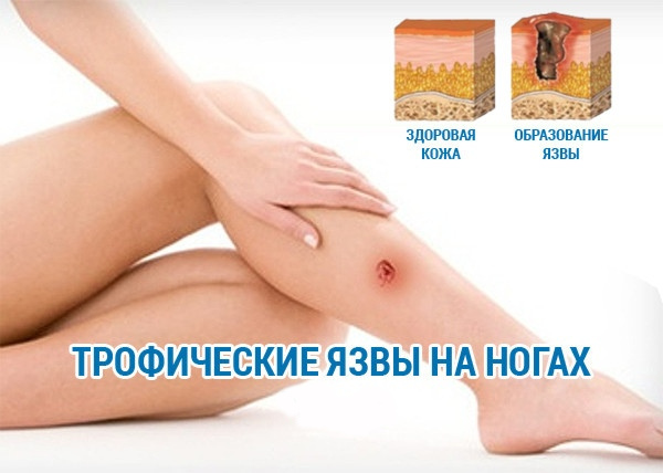 Трофическая язва. Методы лечения.