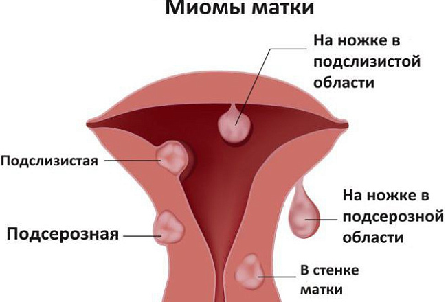 Миома матки, диагностика и лечение в Краснодаре Миома матки, диагностика и лечение в Краснодаре