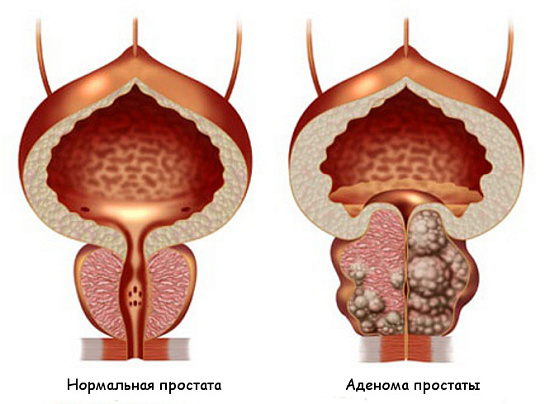 Аденома предстательной железы, качественная диагностика и лечение в Краснодаре.