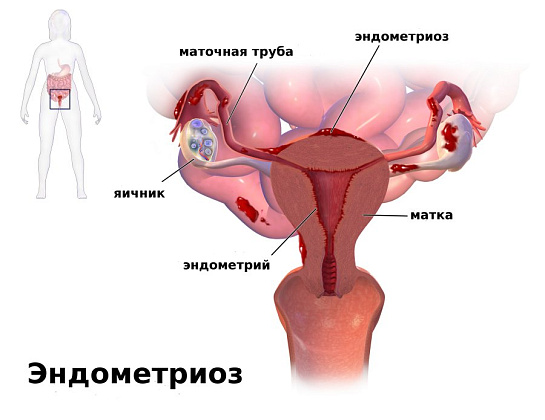Эндометриоз диагностика и лечение в Краснодаре